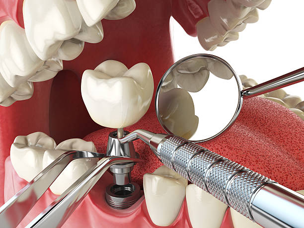 Best Emergency Root Canal Treatment in Tecumseh, MI